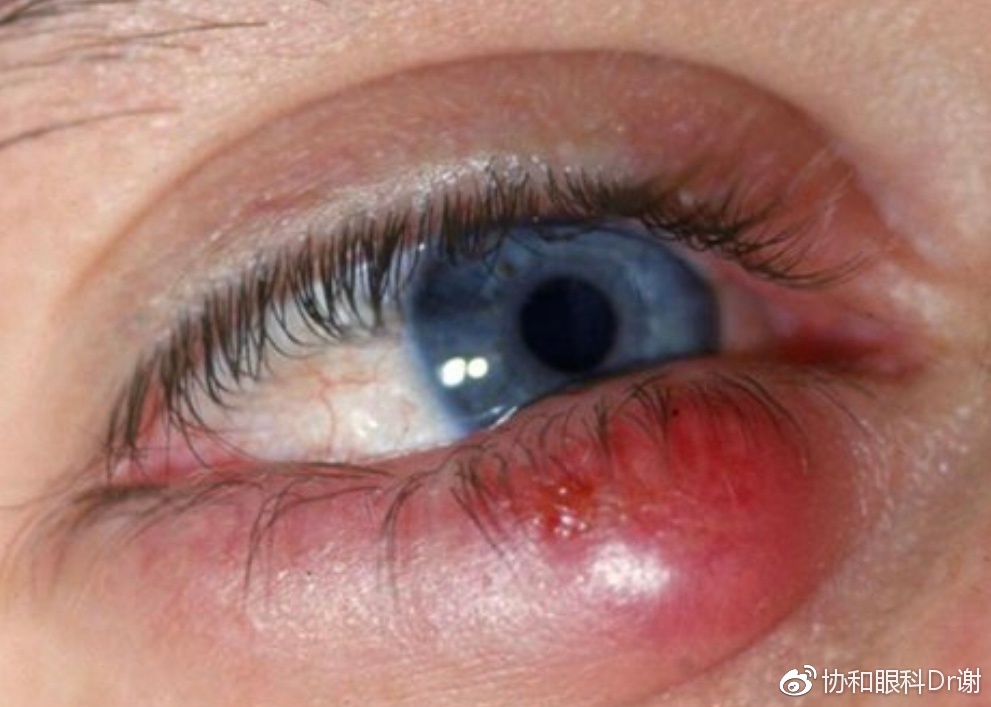 8種眼部問題麥粒腫.jpg